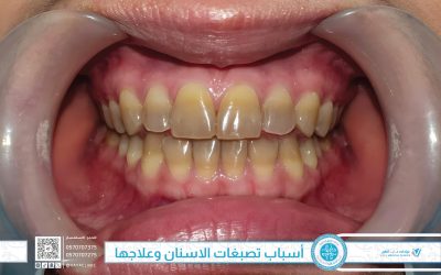 أسباب تصبغات الاسنان وعلاجها – عيادات فايا الطبية