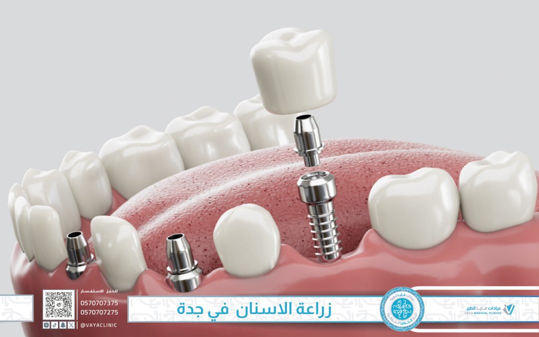 زراعة الاسنان  في جدة – الحل الأمثل لاستعادة الابتسامة وتعويض الاسنان المفقودة