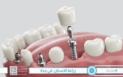 زراعة الاسنان  في جدة – الحل الأمثل لاستعادة الابتسامة وتعويض الاسنان المفقودة