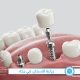 زراعة الاسنان وتعويض الاسنان المفقودة