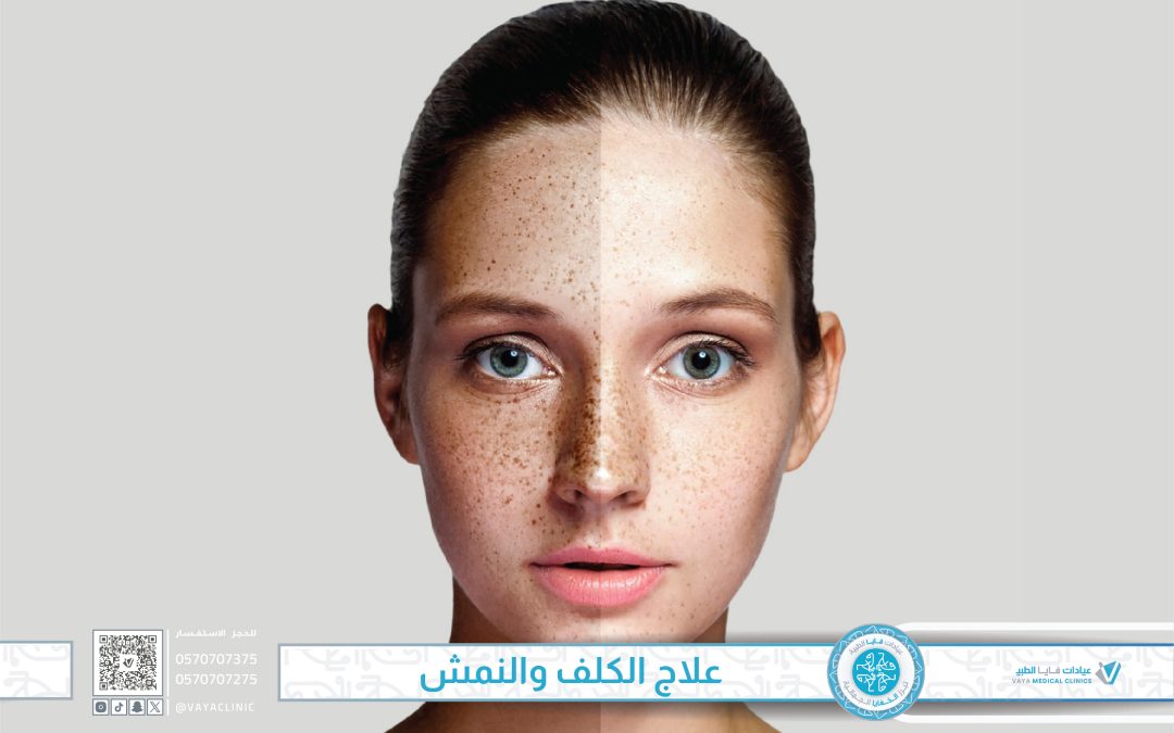 علاج الكلف والنمش – دليل شامل لأسباب ظهور الكلف والنمش طرق علاجهما