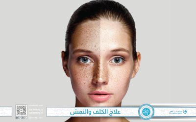 علاج الكلف والنمش – دليل شامل لأسباب ظهور الكلف والنمش طرق علاجهما