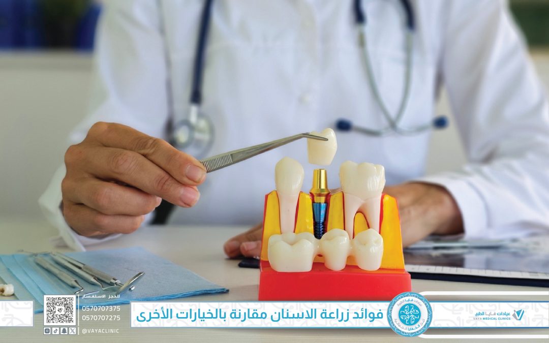 فوائد زراعة الاسنان مقارنة بالخيارات الأخرى: لماذا تُعد الاختيار الذكي؟