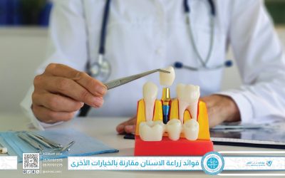 فوائد زراعة الاسنان مقارنة بالخيارات الأخرى: لماذا تُعد الاختيار الذكي؟