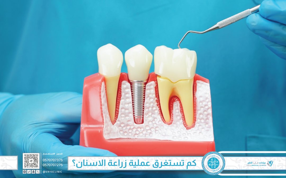 كم تستغرق عملية زراعة الاسنان؟ دليل شامل من البداية حتى الابتسامة النهائية