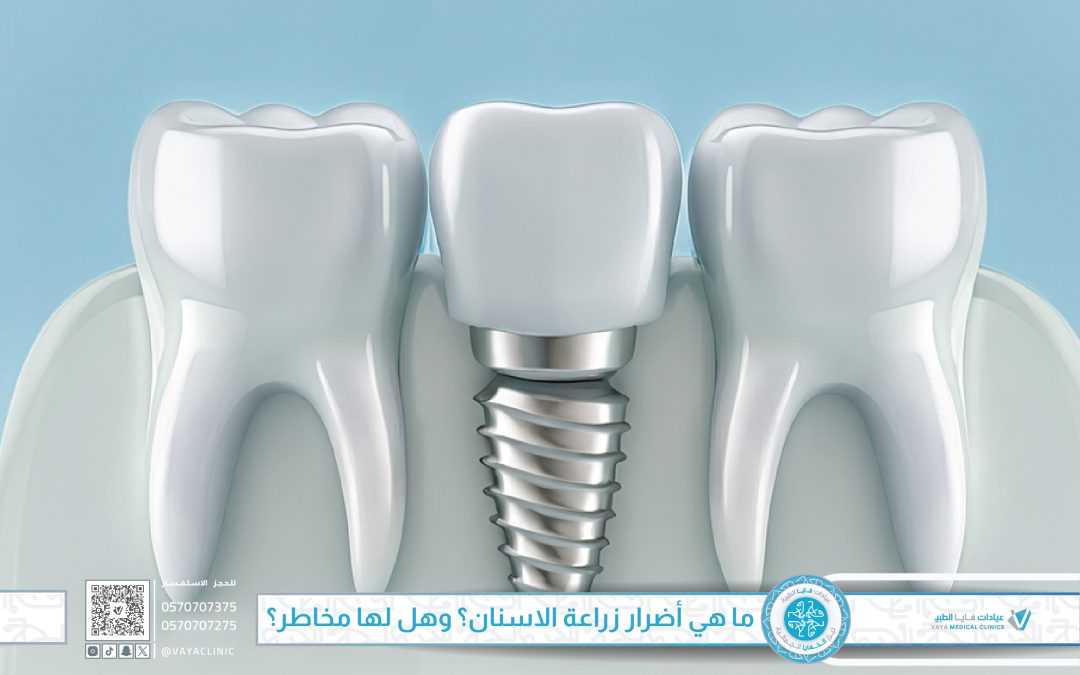 ما هي أضرار زراعة الاسنان؟ وهل لها مخاطر؟ دليل شامل للوقاية والاختيار الآمن