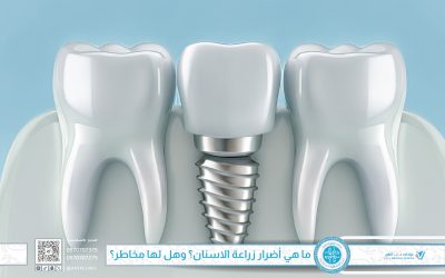 ما هي أضرار زراعة الاسنان؟ وهل لها مخاطر؟ دليل شامل للوقاية والاختيار الآمن