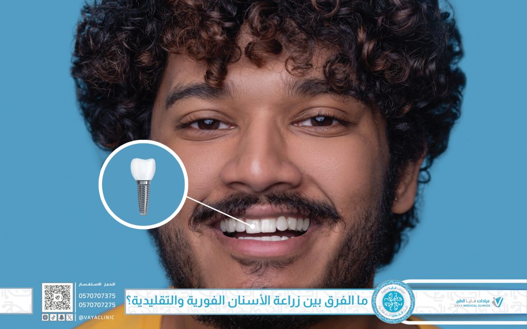 ما الفرق بين زراعة الأسنان الفورية والتقليدية؟ دليل مُفصَّل لاختيار الأفضل
