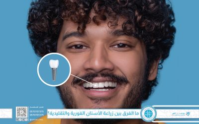 ما الفرق بين زراعة الأسنان الفورية والتقليدية؟ دليل مُفصَّل لاختيار الأفضل