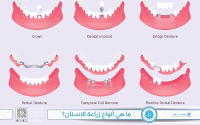 ما هي أنواع زراعة الاسنان وأيهما يناسبك؟