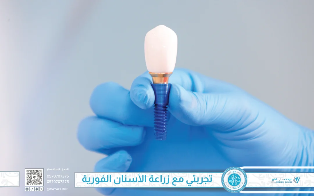 تجربتي مع زراعة الأسنان الفورية في جدة: ابتسامة جديدة في يوم واحد مع عيادات فايا الطبية