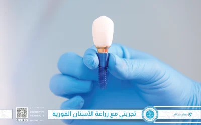 تجربتي مع زراعة الأسنان الفورية في جدة: ابتسامة جديدة في يوم واحد مع عيادات فايا الطبية